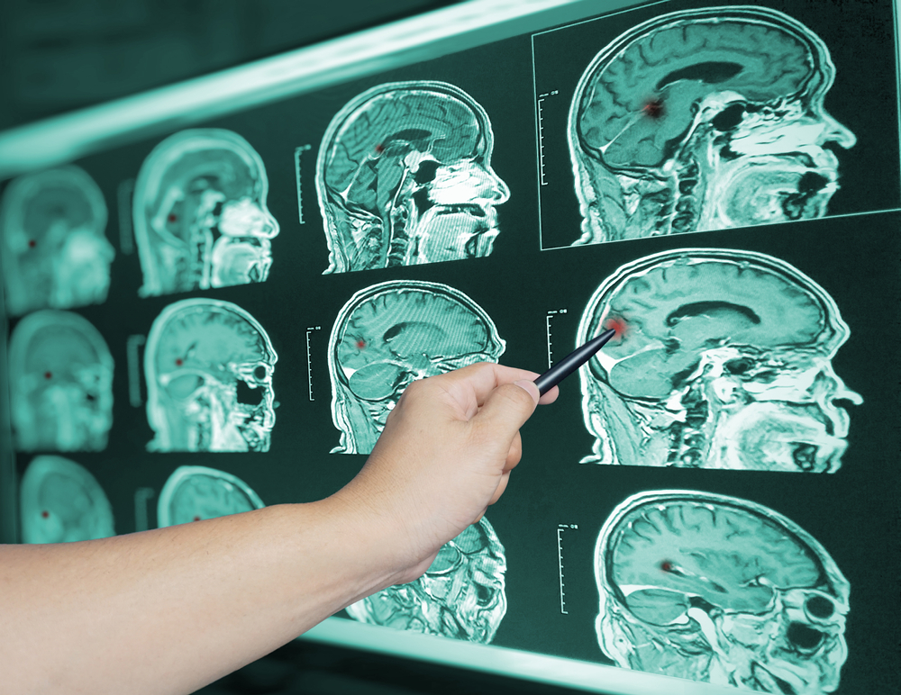 What Are Some Of The Most Common Signs Of A Traumatic Brain Injury?